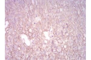 Immunohistochemical analysis of paraffin-embedded ovarian cancer tissues using CK5 mouse mAb with DAB staining. (Cytokeratin 5 抗体  (AA 258-357))