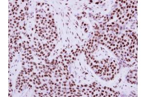 IHC-P Image Immunohistochemical analysis of paraffin-embedded human breast cancer, using KAP1, antibody at 1:500 dilution.