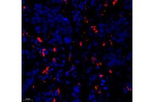 Immunofluorescence of paraffin embedded human esophagus cancer using c-caspase3 (ABIN7073336) at dilution of 1:500 (400x lens) (Caspase 3 抗体  (cleaved))