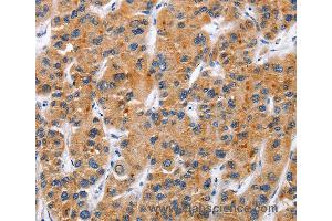 Immunohistochemistry of Human gastric cancer using TNFRSF9 Polyclonal Antibody at dilution of 1:50