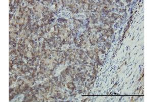 Immunoperoxidase of monoclonal antibody to EMP3 on formalin-fixed paraffin-embedded human lymphoma tissue. (EMP3 抗体  (AA 1-163))