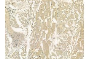 ABIN6263594 and ABIN6276436 at 1/100 staining human lung adenocarcinoma by IHC-P. (NEK8 抗体  (Internal Region))