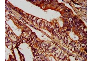 IHC image of ABIN7170916 diluted at 1:300 and staining in paraffin-embedded human colon cancer performed on a Leica BondTM system. (SUCLG2 抗体  (AA 161-292))