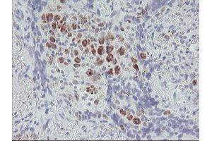 Immunohistochemical staining of paraffin-embedded Carcinoma of Human lung tissue using anti-ACSF2 mouse monoclonal antibody. (ACSF2 抗体)