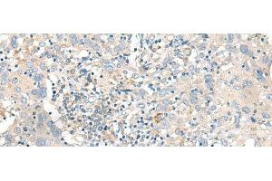 Immunohistochemistry of paraffin-embedded Human cervical cancer tissue using GART Polyclonal Antibody at dilution of 1:30(x200) (GART 抗体)