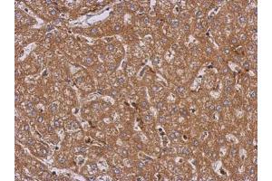 IHC-P Image Immunohistochemical analysis of paraffin-embedded human hepatoma, using LRRN2, antibody at 1:500 dilution. (LRRN2 抗体)