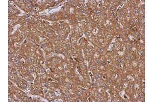 IHC-P Image Immunohistochemical analysis of paraffin-embedded human hepatoma, using LRRN2, antibody at 1:500 dilution. (LRRN2 抗体)