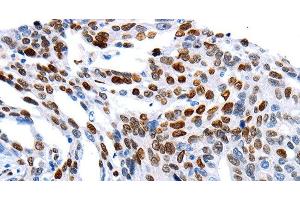 Immunohistochemistry of paraffin-embedded Human ovarian cancer using MUTYH Polyclonal Antibody at dilution of 1:60 (MUTYH 抗体)