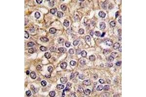 IHC analysis of FFPE human prostate carcinoma tissue stained with IL1R1 antibody (IL1R1 抗体  (AA 474-503))