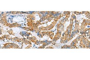 Immunohistochemistry of paraffin-embedded Human thyroid cancer tissue using FBXO8 Polyclonal Antibody at dilution of 1:40(x200) (FBXO8 抗体)