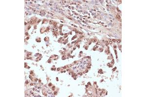 Immunohistochemistry of paraffin-embedded human lung cancer using Rad50 antibody (ABIN3017329, ABIN3017330, ABIN3017331 and ABIN6220043) at dilution of 1:100 (40x lens). (RAD50 抗体  (AA 1-100))