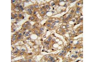 IHC analysis of FFPE human hepatocarcinoma with IFNB1 antibody (IFNB1 抗体  (AA 39-66))