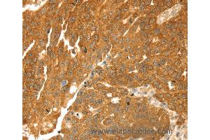 Immunohistochemistry of Human breast cancer using TMEFF2 Polyclonal Antibody at dilution of 1:35 (TMEFF2 抗体)