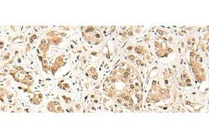 Immunohistochemistry of paraffin-embedded Human prost ate cancer tissue using GPR139 Polyclonal Antibody at dilution of 1:50(x200) (GPR139 抗体)
