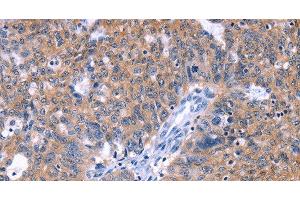 Immunohistochemistry of paraffin-embedded Human ovarian cancer tissue using ZNF395 Polyclonal Antibody at dilution 1:40 (ZNF395 抗体)