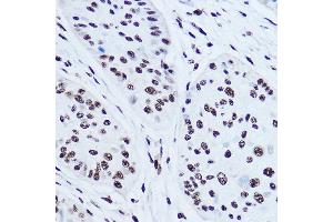 Immunohistochemistry of paraffin-embedded human esophageal cancer using SSB Rabbit pAb (ABIN3015264, ABIN3015265, ABIN3015266 and ABIN6213909) at dilution of 1:300 (40x lens). (SSB 抗体  (AA 166-408))