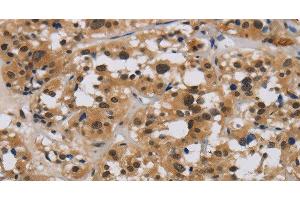 Immunohistochemistry of paraffin-embedded Human thyroid cancer tissue using E2F4 Polyclonal Antibody at dilution 1:40 (E2F4 抗体)