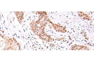 Immunohistochemistry of paraffin-embedded Human esophagus cancer tissue using TRMT12 Polyclonal Antibody at dilution of 1:80(x200)