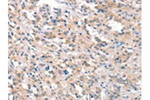The image on the left is immunohistochemistry of paraffin-embedded Human thyroid cancer tissue using ABIN7191162(KCNB1 Antibody) at dilution 1/40, on the right is treated with synthetic peptide. (Kv2.1/KCNB1 抗体)