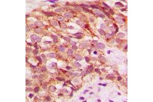 Immunohistochemical analysis of Glycerate Kinase staining in human breast cancer formalin fixed paraffin embedded tissue section. (GLYCTK 抗体)