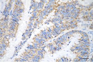 Immunohistochemistry was performed on paraffin-embedded human sigmoid colon carcinoma using COXIV antibody (ABIN7798246), 1:200). (Recombinant COX IV 抗体)