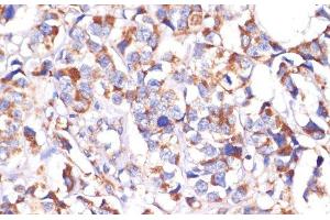 Immunohistochemistry of paraffin-embedded Human breast cancer using STOML2 Polyclonal Antibody at dilution of 1:100 (40x lens). (STOML2 抗体)
