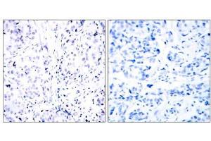 Immunohistochemical analysis of paraffin-embedded human breast carcinoma tissue using Rb (Ab-807) antibody (E021109). (Retinoblastoma 1 抗体)