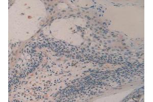 IHC-P analysis of Human Skin Cancer Tissue, with DAB staining. (H2AFY 抗体  (AA 109-369))