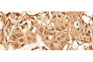 Immunohistochemistry of paraffin-embedded Human colorectal cancer tissue using BRF2 Polyclonal Antibody at dilution of 1:40(x200) (BRF2 抗体)