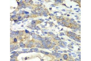 Immunohistochemistry of paraffin-embedded Human gastric cancer using CHMP2B Polyclonal Antibody at dilution of 1:100 (40x lens). (CHMP2B 抗体)