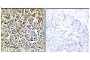 Immunohistochemistry analysis of paraffin-embedded human lung carcinoma tissue using COL6A2 antibody. (COL6A2 抗体  (Internal Region))