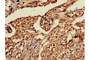 Immunohistochemistry of paraffin-embedded human lung cancer using ABIN7164763 at dilution of 1:100 (PRR11 抗体  (AA 1-360))