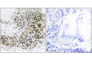 Immunohistochemistry analysis of paraffin-embedded human lung carcinoma tissue, using TRPS1 Antibody. (TRPS1 抗体  (AA 121-170))