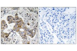 Immunohistochemistry analysis of paraffin-embedded human breast carcinoma tissue using KCNK15 antibody. (KCNK15 抗体  (C-Term))