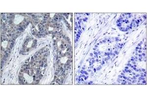 Immunohistochemistry analysis of paraffin-embedded human breast carcinoma, using IRS-1 (Phospho-Ser636) Antibody. (IRS1 抗体  (pSer636))