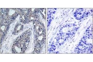 Immunohistochemistry analysis of paraffin-embedded human breast carcinoma, using IRS-1 (Phospho-Ser636) Antibody.