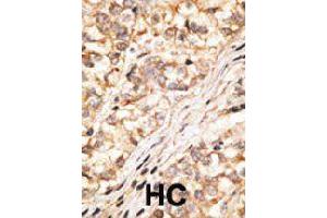 Formalin-fixed and paraffin-embedded human hepatocellular carcinoma tissue reacted with GJD2 polyclonal antibody  , which was peroxidase-conjugated to the secondary antibody, followed by DAB staining. (GJD2 抗体  (C-Term))
