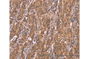 Immunohistochemistry of Human colon cancer using FBXO31 Polyclonal Antibody at dilution of 1:40 (FBXO31 抗体)