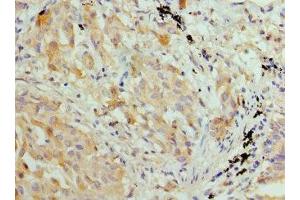 Immunohistochemistry of paraffin-embedded human lung cancer using ABIN7155429 at dilution of 1: 100 (HIST2H3A 抗体  (AA 108-136))