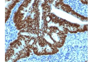 Formalin-fixed, paraffin-embedded human Colon Carcinoma stained with CDX2 Mouse Monoclonal Antibody (CDX2/1690). (CDX2 抗体  (AA 150-249))
