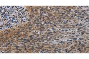 Immunohistochemistry of paraffin-embedded Human cervical cancer tissue using CCL1 Polyclonal Antibody at dilution 1:50 (CCL1 抗体)
