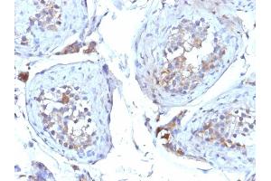 Formalin-fixed, paraffin-embedded human Testicular Carcinoma stained with SHBG Mouse Monoclonal Antibody (SHBG/245). (SHBG 抗体)