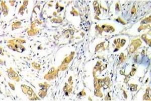 Immunohistochemistry (IHC) analyzes of p-FKHR/FOXO1A antibody in paraffin-embedded human breast carcinoma tissue. (FOXO1 抗体  (pSer319))