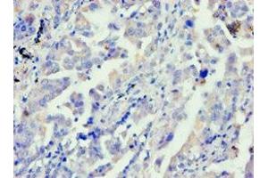 Immunohistochemistry of paraffin-embedded human lung cancer using ABIN7144040 at dilution of 1:100 (FE65 抗体  (AA 361-710))