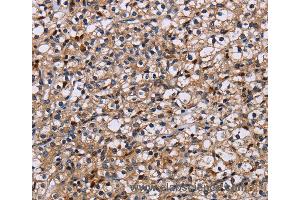 Immunohistochemistry of Human prostate cancer using NCSTN Polyclonal Antibody at dilution of 1:50 (Nicastrin 抗体)