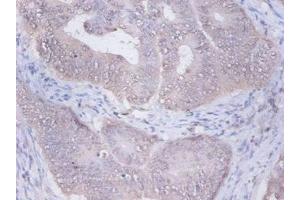 Immunohistochemistry of paraffin-embedded human colon cancer using ABIN7153940 at dilution of 1:100 (PRKCSH 抗体  (AA 15-302))