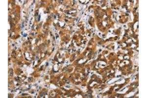 The image on the left is immunohistochemistry of paraffin-embedded Human esophagus cancer tissue using ABIN7192349(SH2B2 Antibody) at dilution 1/30, on the right is treated with synthetic peptide. (SH2B2 抗体)