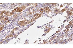 ABIN6279710 at 1/100 staining Human liver cancer tissue by IHC-P. (RFTN2 抗体  (C-Term))