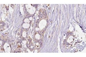 ABIN6267634 at 1/100 staining Human liver cancer tissue by IHC-P. (GRIN2B 抗体  (pTyr1474))