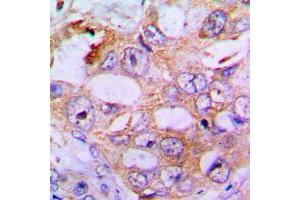 Immunohistochemical analysis of IRS1 (pS636) staining in human lung cancer formalin fixed paraffin embedded tissue section. (IRS1 抗体  (pSer636))